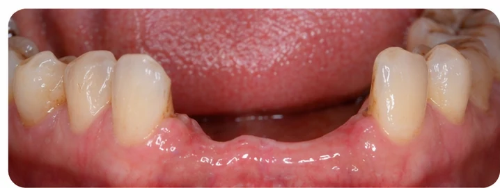 Bildverlauf Denticor – Schritt 1: provisorische Versorgung – unterer Eckzahn und zwei Prämolaren