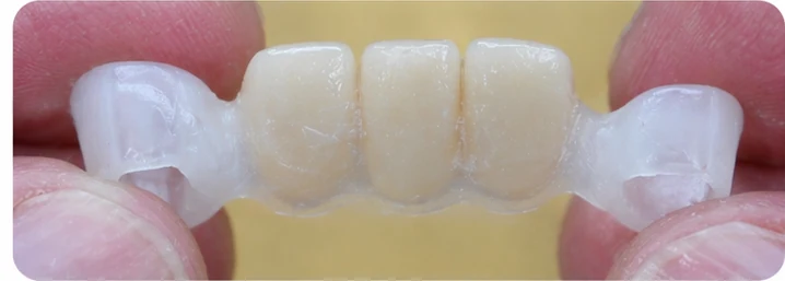 Bildverlauf Denticor – Schritt 3: provisorische Versorgung – unterer Eckzahn und zwei Prämolaren