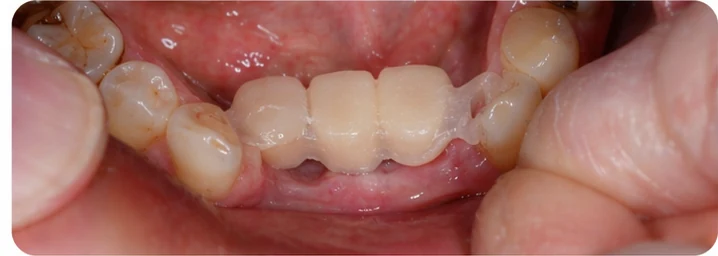 Bildverlauf Denticor – Schritt 5: provisorische Versorgung – unterer Eckzahn und zwei Prämolaren