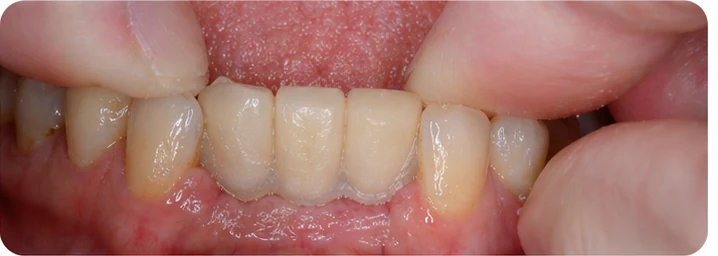 Bildverlauf Denticor – Schritt 6: provisorische Versorgung – unterer Eckzahn und zwei Prämolaren