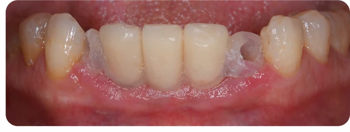Bildverlauf Denticor – Schritt 7: provisorische Versorgung – unterer Eckzahn und zwei Prämolaren