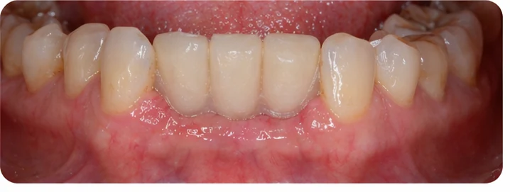 Bildverlauf Denticor – Schritt 8: provisorische Versorgung – unterer Eckzahn und zwei Prämolaren