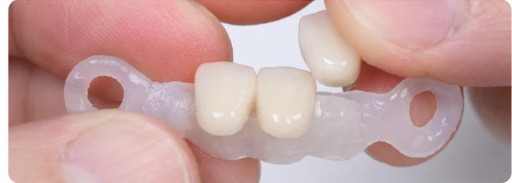 Bildverlauf Denticor — Schritt 3: provisorische Versorgung — unterer mittlerer, seitlicher Schneidezahn und Eckzahn