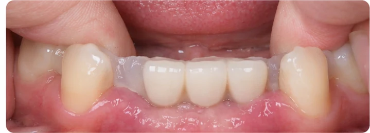 Bildverlauf Denticor — Schritt 5: provisorische Versorgung — unterer mittlerer, seitlicher Schneidezahn und Eckzahn