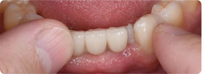 Bildverlauf Denticor — Schritt 6: provisorische Versorgung — unterer mittlerer, seitlicher Schneidezahn und Eckzahn
