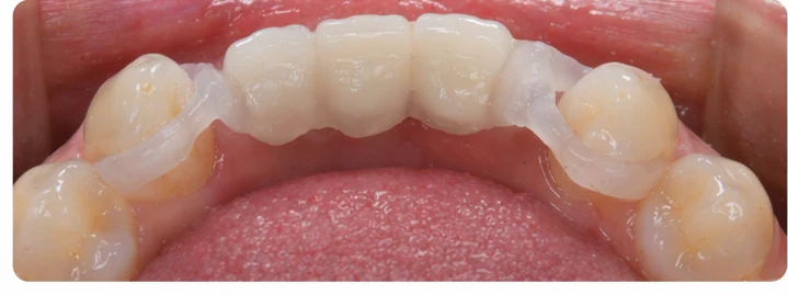 Bildverlauf Denticor — Schritt 7: provisorische Versorgung — unterer mittlerer, seitlicher Schneidezahn und Eckzahn