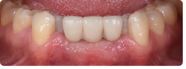 Bildverlauf Denticor — Schritt 8: provisorische Versorgung — unterer mittlerer, seitlicher Schneidezahn und Eckzahn