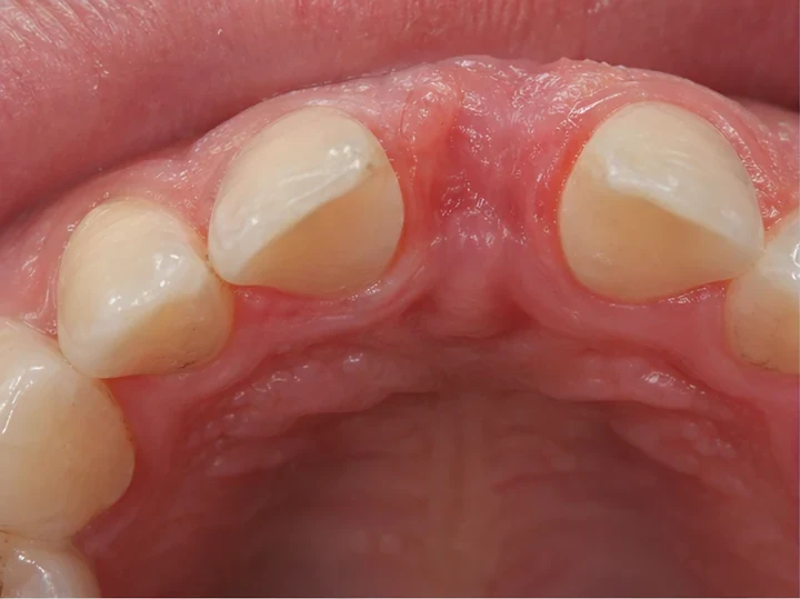 Bildverlauf Denticor – Schritt 5: provisorische Versorgung – ein unterer Frontzahn