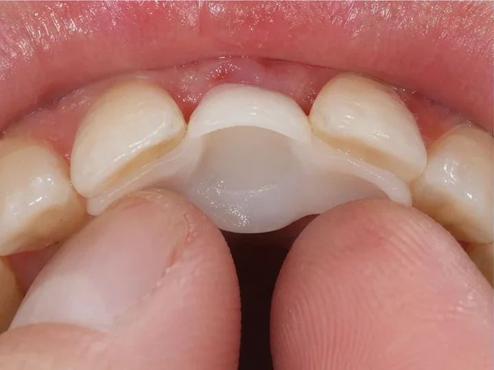 Bildverlauf Denticor – Schritt 7: provisorische Versorgung – ein unterer Frontzahn