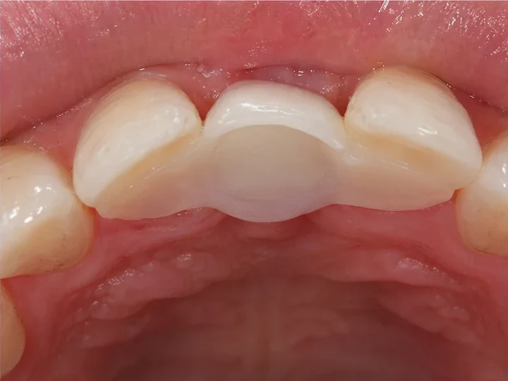 Ansicht von hinten: neue Zahnkrone zwischen den eigenen Zähnen, gehalten durch eine DentiFlex-Brücke