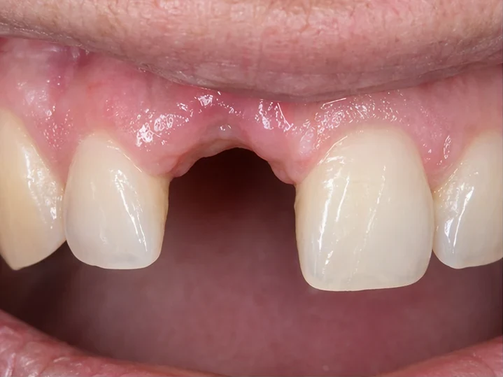 Bildverlauf Denticor – Schritt 1: provisorische Versorgung – ein unterer Frontzahn