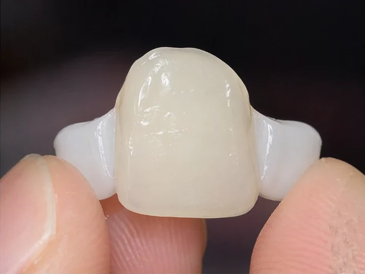 Bildverlauf Denticor – Schritt 2: provisorische Versorgung – ein unterer Frontzahn