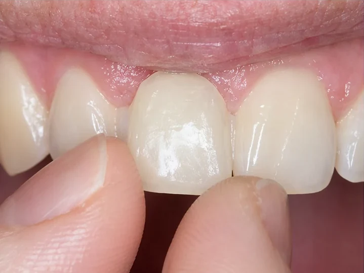 Bildverlauf Denticor – Schritt 3: provisorische Versorgung – ein unterer Frontzahn