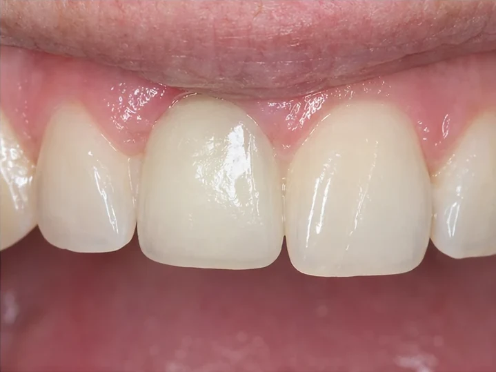 Bildverlauf Denticor – Schritt 4: provisorische Versorgung – ein unterer Frontzahn