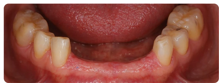 Bildverlauf Denticor – Schritt 1: provisorische Versorgung – zwei obere Prämolaren und ein Backenzahn