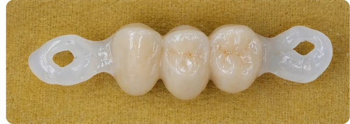 Bildverlauf Denticor – Schritt 3: provisorische Versorgung – zwei obere Prämolaren und ein Backenzahn