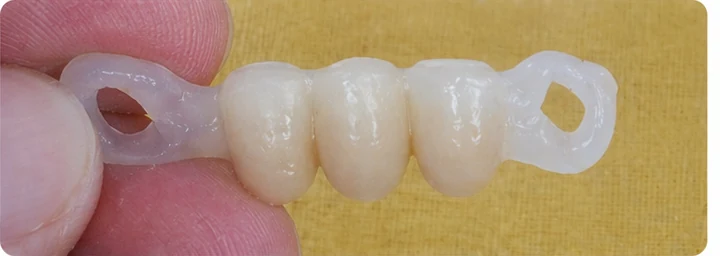 Bildverlauf Denticor – Schritt 4: provisorische Versorgung – zwei obere Prämolaren und ein Backenzahn
