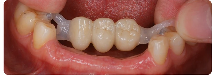 Bildverlauf Denticor – Schritt 5: provisorische Versorgung – zwei obere Prämolaren und ein Backenzahn