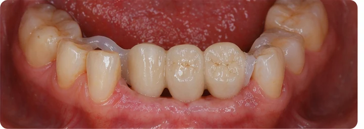 Bildverlauf Denticor – Schritt 6: provisorische Versorgung – zwei obere Prämolaren und ein Backenzahn