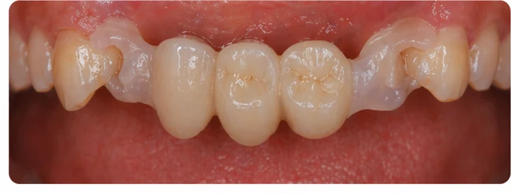 Bildverlauf Denticor – Schritt 7: provisorische Versorgung – zwei obere Prämolaren und ein Backenzahn