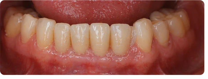 Bildverlauf Denticor – Schritt 8: provisorische Versorgung – zwei obere Prämolaren und ein Backenzahn