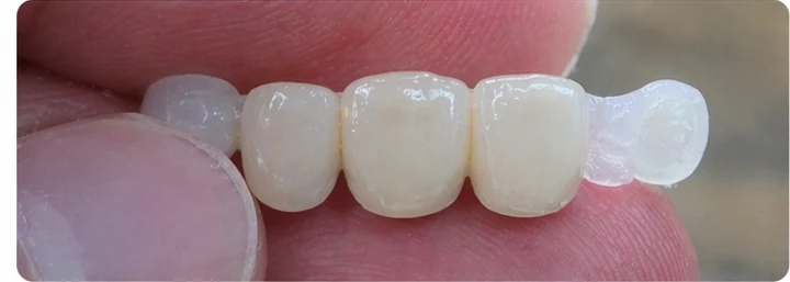 Bildverlauf Denticor – Schritt 3: provisorische Versorgung – drei obere Schneidezähne (beide mittleren + seitlicher)