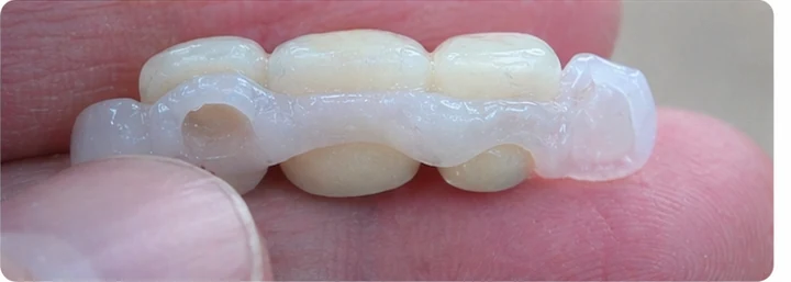 Bildverlauf Denticor – Schritt 4: provisorische Versorgung – drei obere Schneidezähne (beide mittleren + seitlicher)