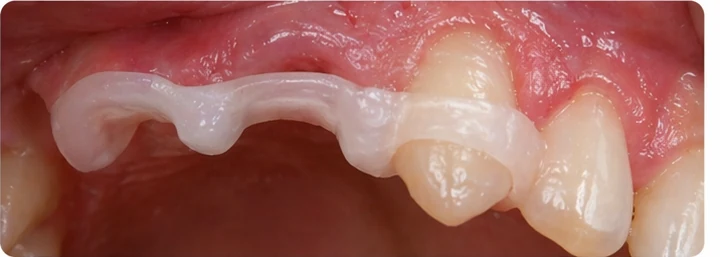 Bildverlauf Denticor – Schritt 6: provisorische Versorgung – drei obere Schneidezähne (beide mittleren + seitlicher)