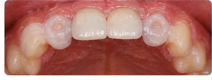 Bildverlauf Denticor – Schritt 7: provisorische Versorgung – drei obere Schneidezähne (beide mittleren + seitlicher)