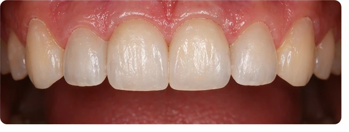 Bildverlauf Denticor – Schritt 8: provisorische Versorgung – drei obere Schneidezähne (beide mittleren + seitlicher)