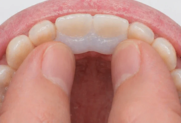 Bildverlauf Denticor — Schritt 7: provisorische Versorgung — zwei obere Frontzähne