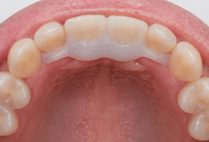 Bildverlauf Denticor — Schritt 8: provisorische Versorgung — zwei obere Frontzähne