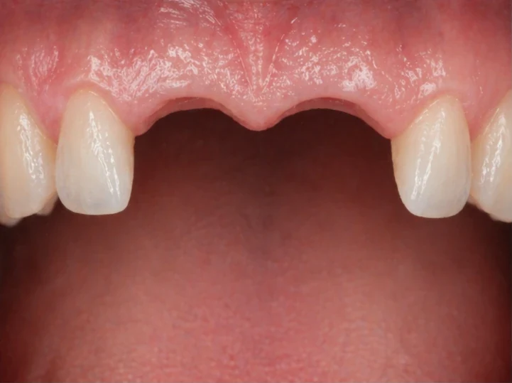 Bildverlauf Denticor — Schritt 1: provisorische Versorgung — zwei obere Frontzähne
