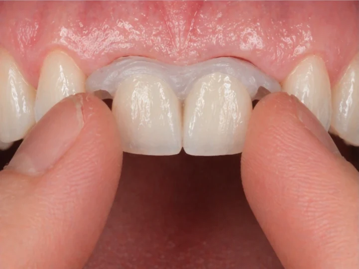 Bildverlauf Denticor — Schritt 3: provisorische Versorgung — zwei obere Frontzähne