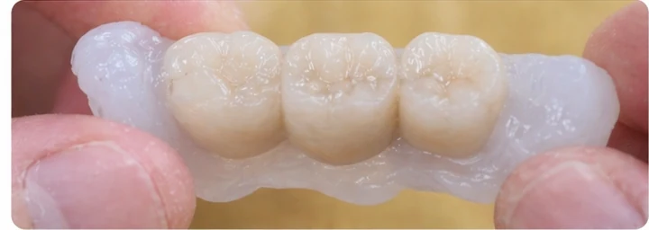 Bildverlauf Denticor – Schritt 1: provisorische Versorgung – drei obere Seitenzähne