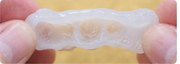 Bildverlauf Denticor – Schritt 2: provisorische Versorgung – drei obere Seitenzähne