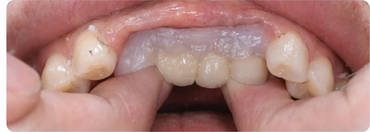 Bildverlauf Denticor – Schritt 3: provisorische Versorgung – drei obere Seitenzähne