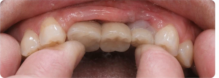 Bildverlauf Denticor – Schritt 4: provisorische Versorgung – drei obere Seitenzähne