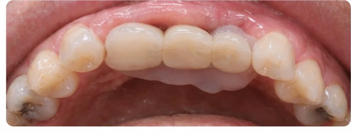 Bildverlauf Denticor – Schritt 5: provisorische Versorgung – drei obere Seitenzähne