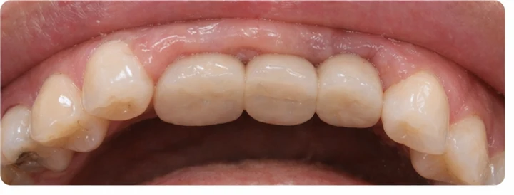 Bildverlauf Denticor – Schritt 6: provisorische Versorgung – drei obere Seitenzähne