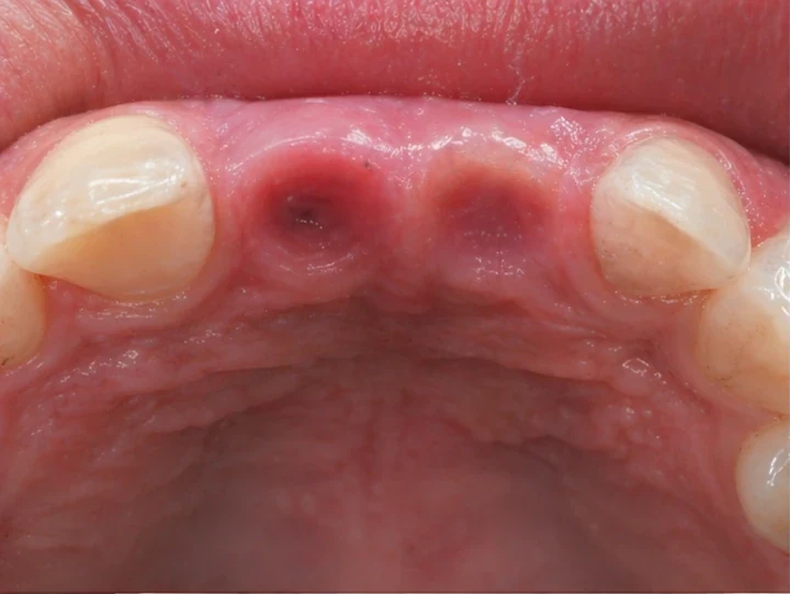 Bildverlauf Denticor – Schritt 5: provisorische Versorgung – oberer seitlicher Schneidezahn und Eckzahn