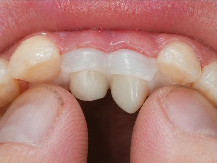 Bildverlauf Denticor – Schritt 7: provisorische Versorgung – oberer seitlicher Schneidezahn und Eckzahn