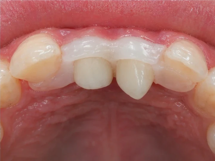 Bildverlauf Denticor – Schritt 8: provisorische Versorgung – oberer seitlicher Schneidezahn und Eckzahn