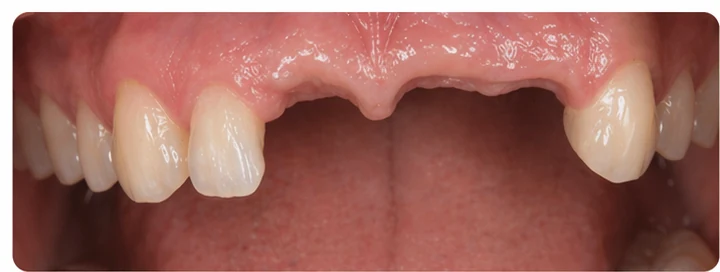 Bildverlauf Denticor – Schritt 1: provisorische Versorgung – oberer Eckzahn und zwei Prämolaren