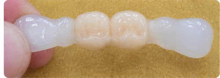 Bildverlauf Denticor – Schritt 3: provisorische Versorgung – oberer Eckzahn und zwei Prämolaren