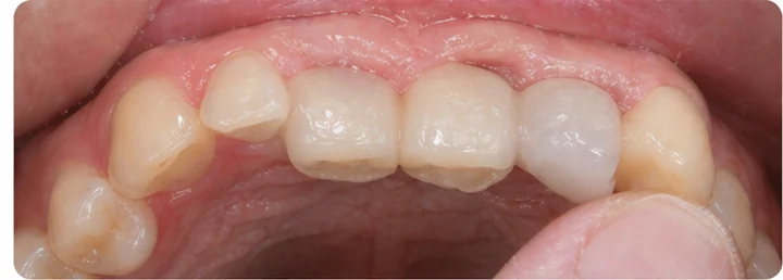 Bildverlauf Denticor – Schritt 5: provisorische Versorgung – oberer Eckzahn und zwei Prämolaren