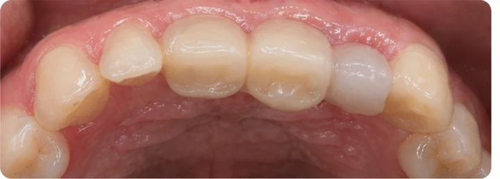 Bildverlauf Denticor – Schritt 6: provisorische Versorgung – oberer Eckzahn und zwei Prämolaren