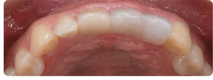 Bildverlauf Denticor – Schritt 7: provisorische Versorgung – oberer Eckzahn und zwei Prämolaren