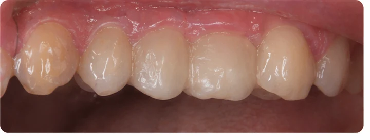 Bildverlauf Denticor – Schritt 8: provisorische Versorgung – oberer Eckzahn und zwei Prämolaren