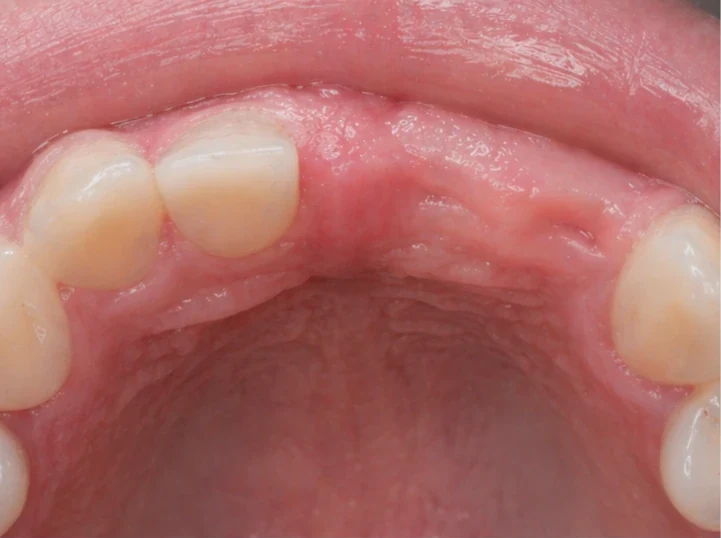 Bildverlauf Denticor – Schritt 5: provisorische Versorgung – oberer mittlerer und seitlicher Schneidezahn